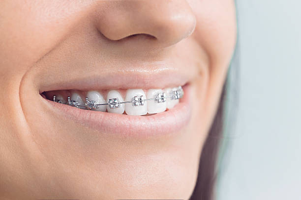 Best Veneers and Lumineers  in White Oak, TX